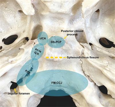 Endoscopic Endonasal Surgical Strategy for Skull Base Chordomas Based on Tumor Growth Directions: Surgical Outcomes of 167 Patients During 3 Years